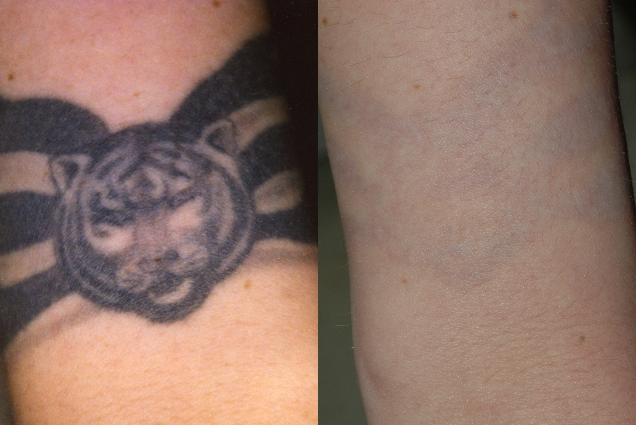 Long-term side effects of laser tattoo removal – Lazoi